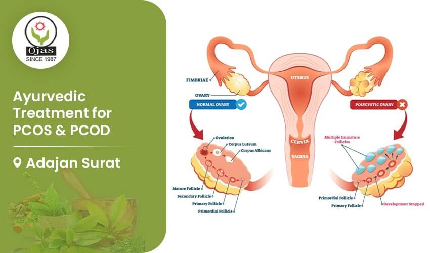 Ayurvedic Treatment for PCOS & PCOD